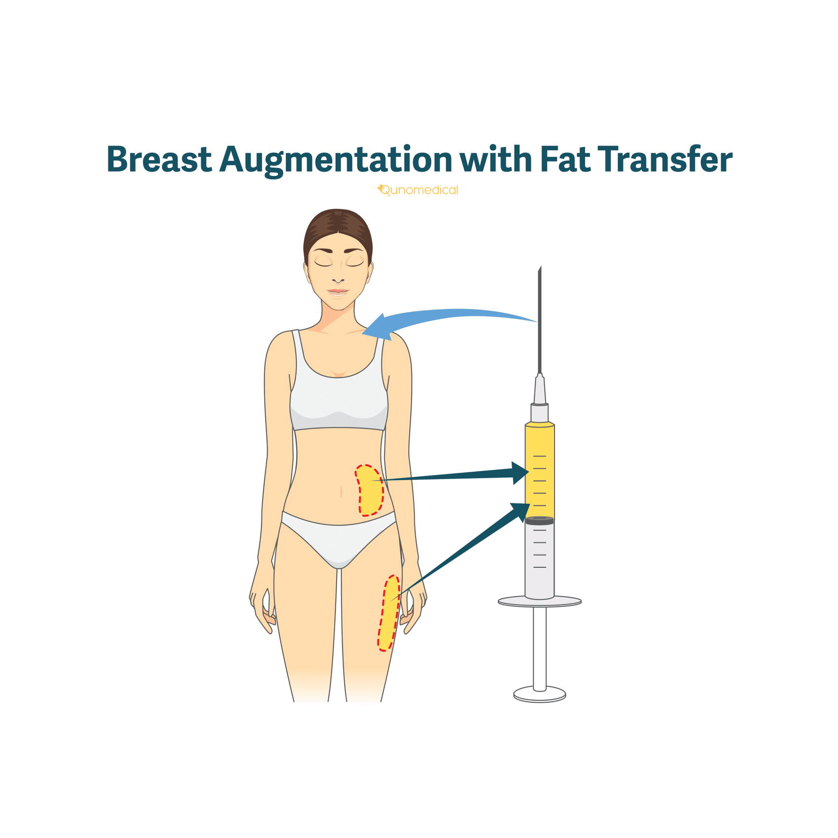 An illustration of how breast augmentation with fat transfer works.