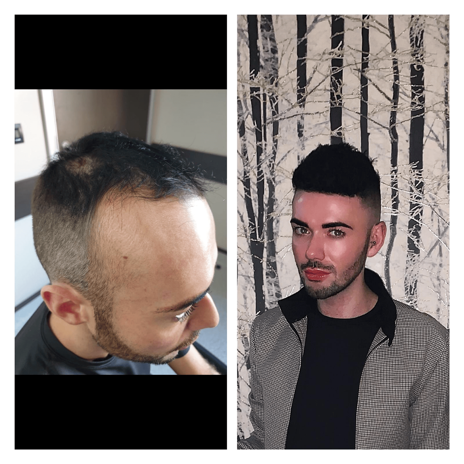 Qunomedical Interviews: Iwan's Hair Transplant in Turkey_Image4
