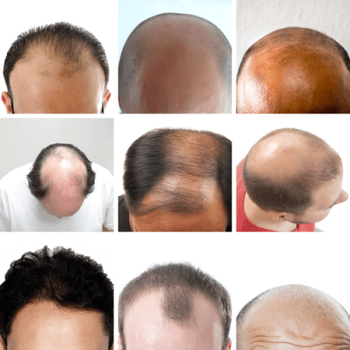 Diferentes tipos de calvicie