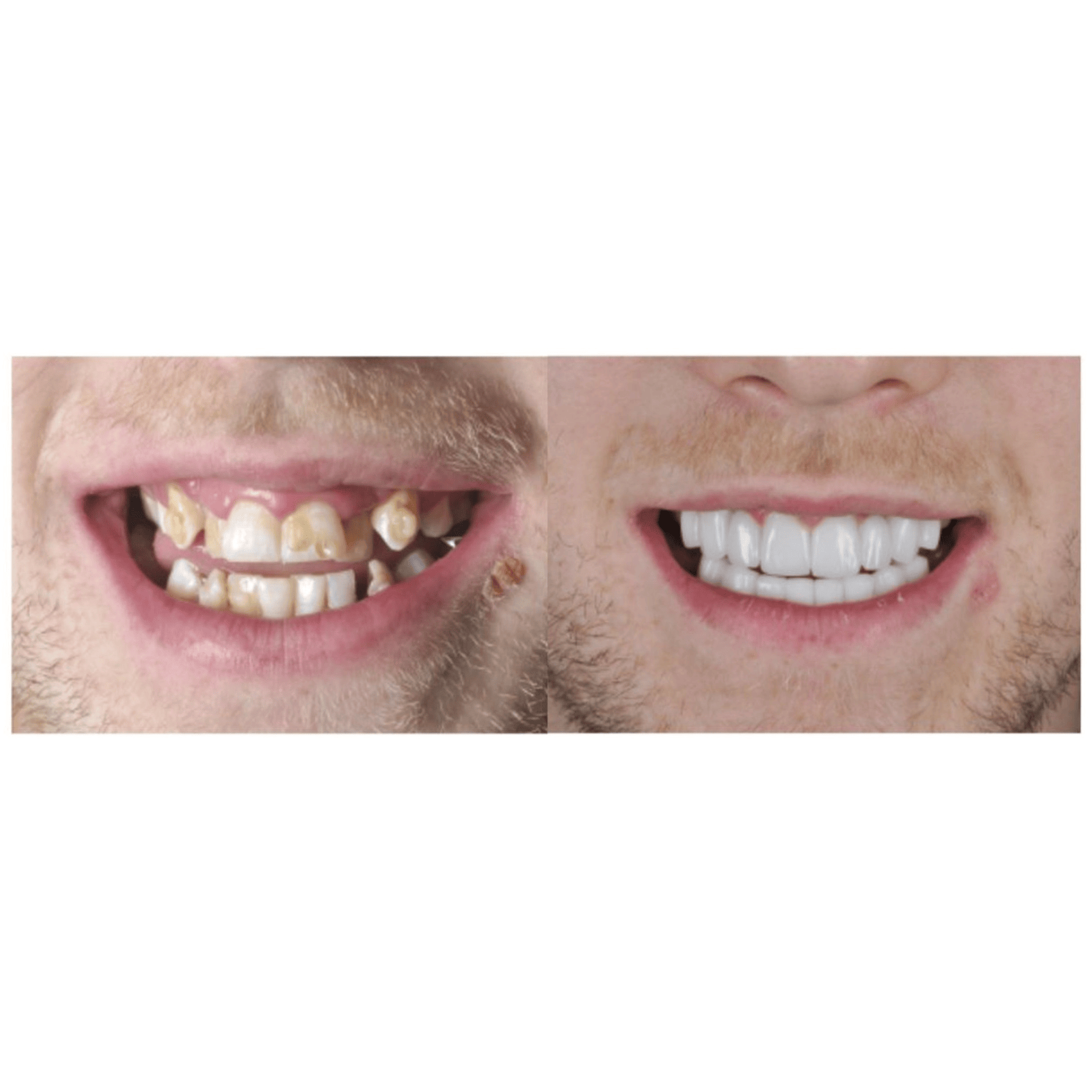 Patient showing teeth before and after having dental veneers fitted.