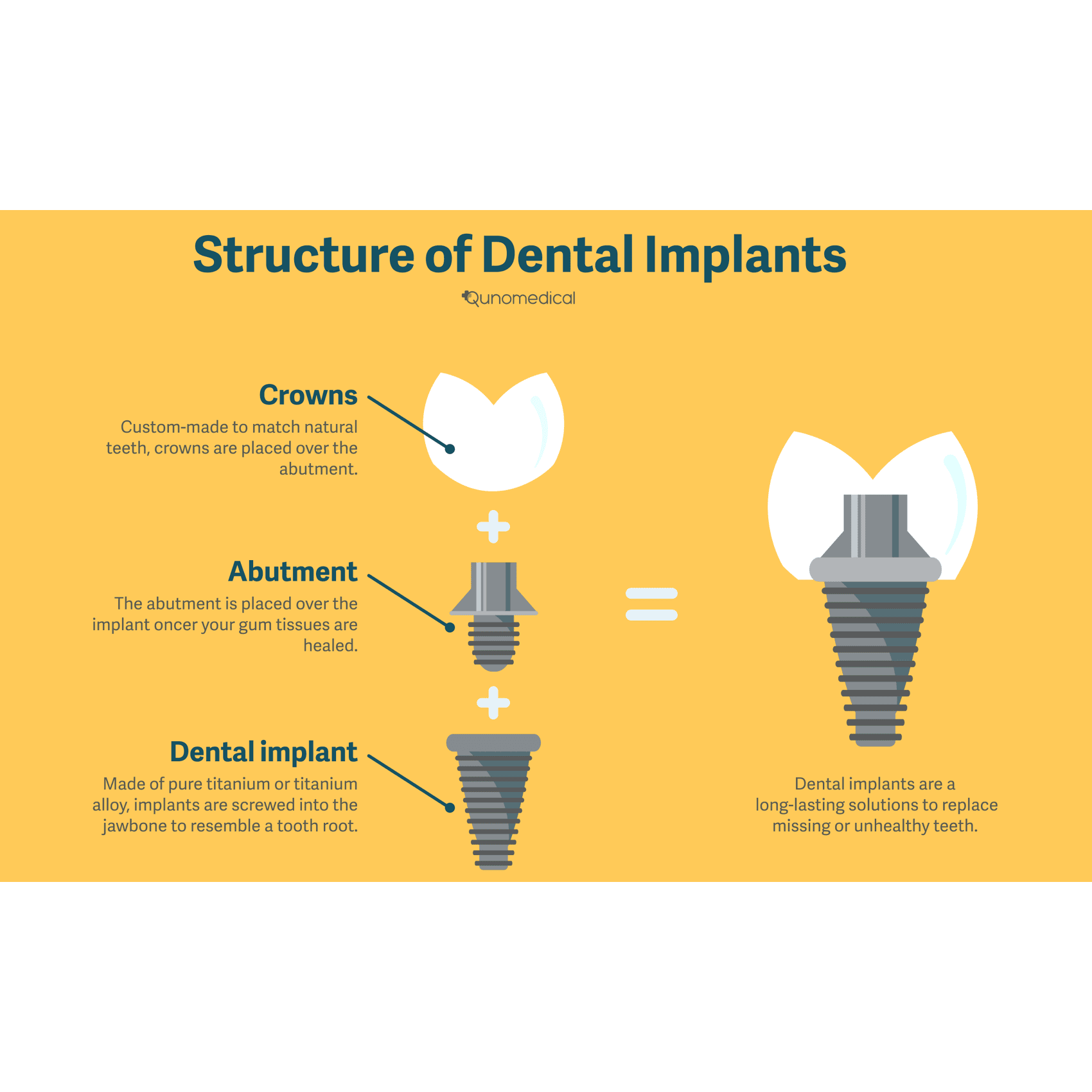 Diagram showing the structure of a dental implant.