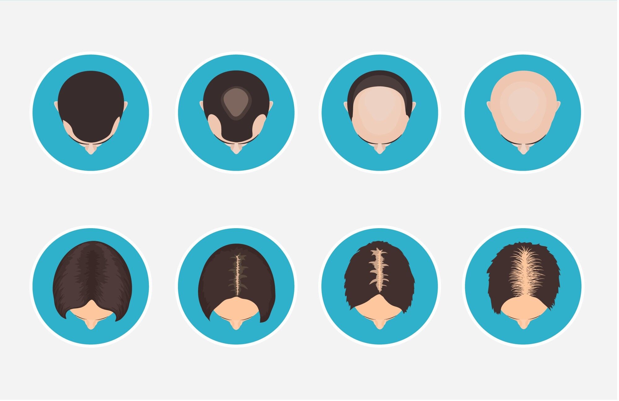 female-male-hair-loss