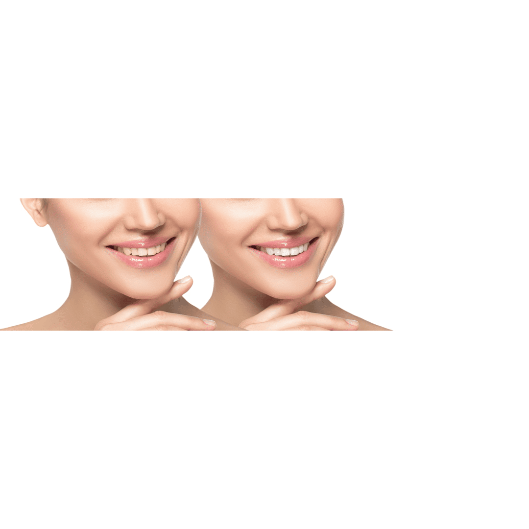 Woman smiling before and after having veneers fitted.