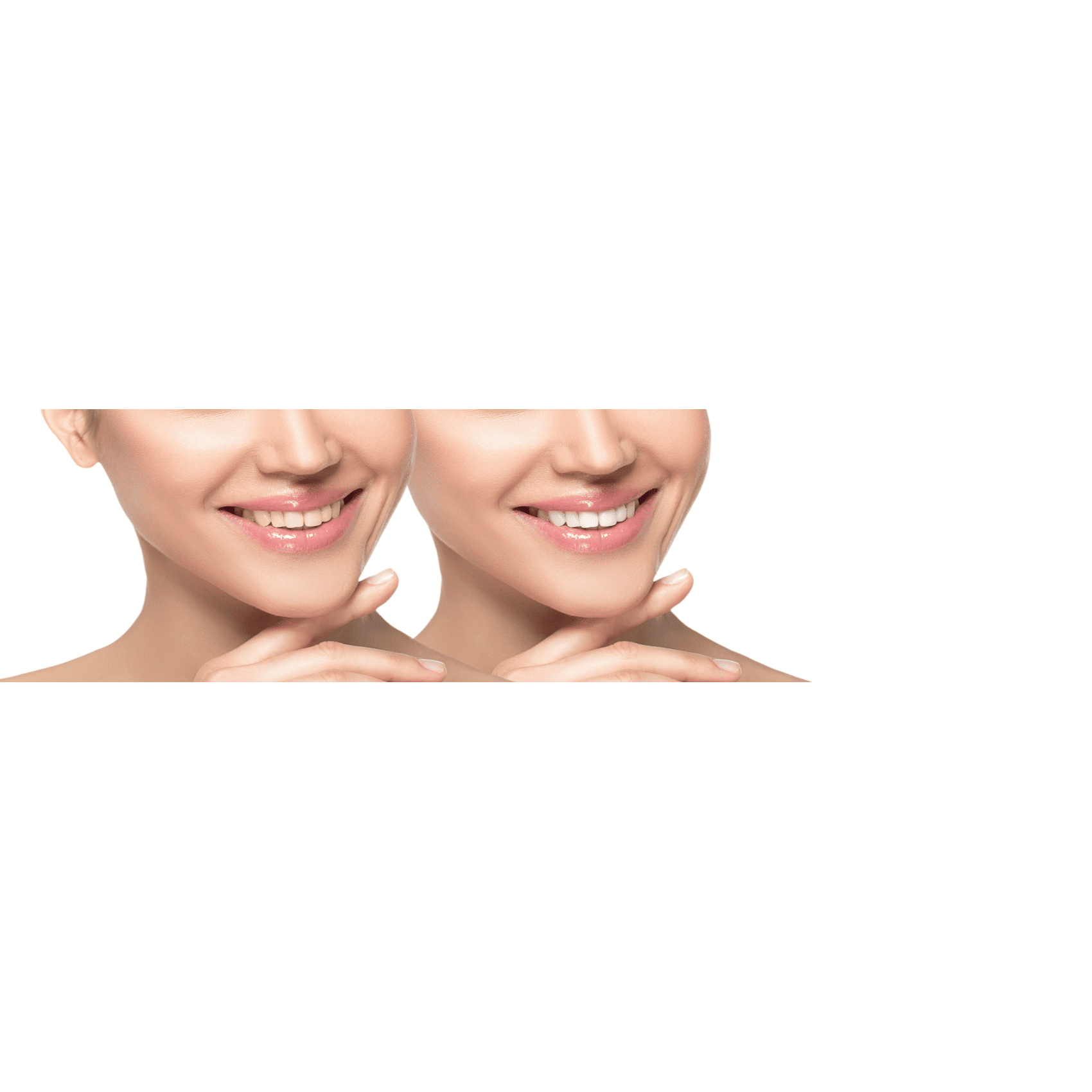 Woman smiling before and after having veneers fitted.