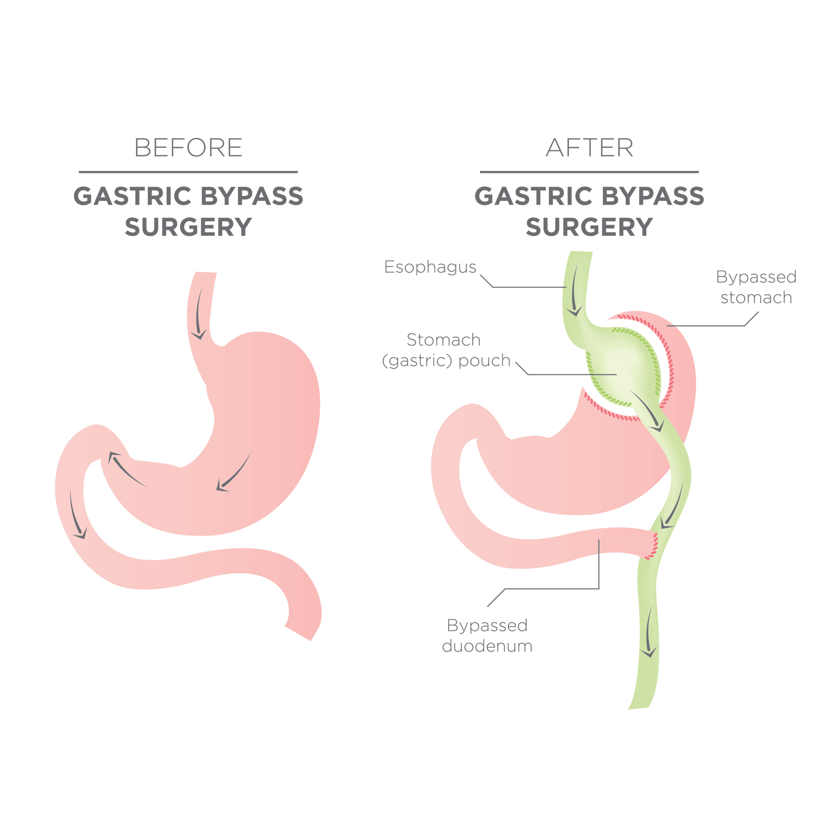 EN image 2 for Bariatric Surgery Cost Guide