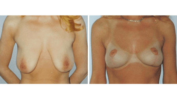 Woman facing camera showing breasts before and after undergoing breast lift surgery.