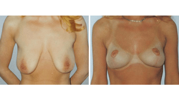 Woman facing camera showing breasts before and after undergoing breast lift surgery.