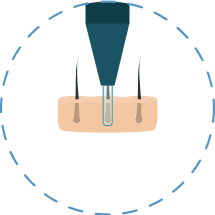 Illustration showing the first step of the FUE hair transplant procedure.