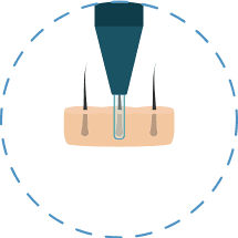 Illustration showing the first step of the FUE hair transplant procedure.
