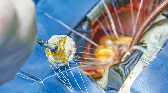Biological valves