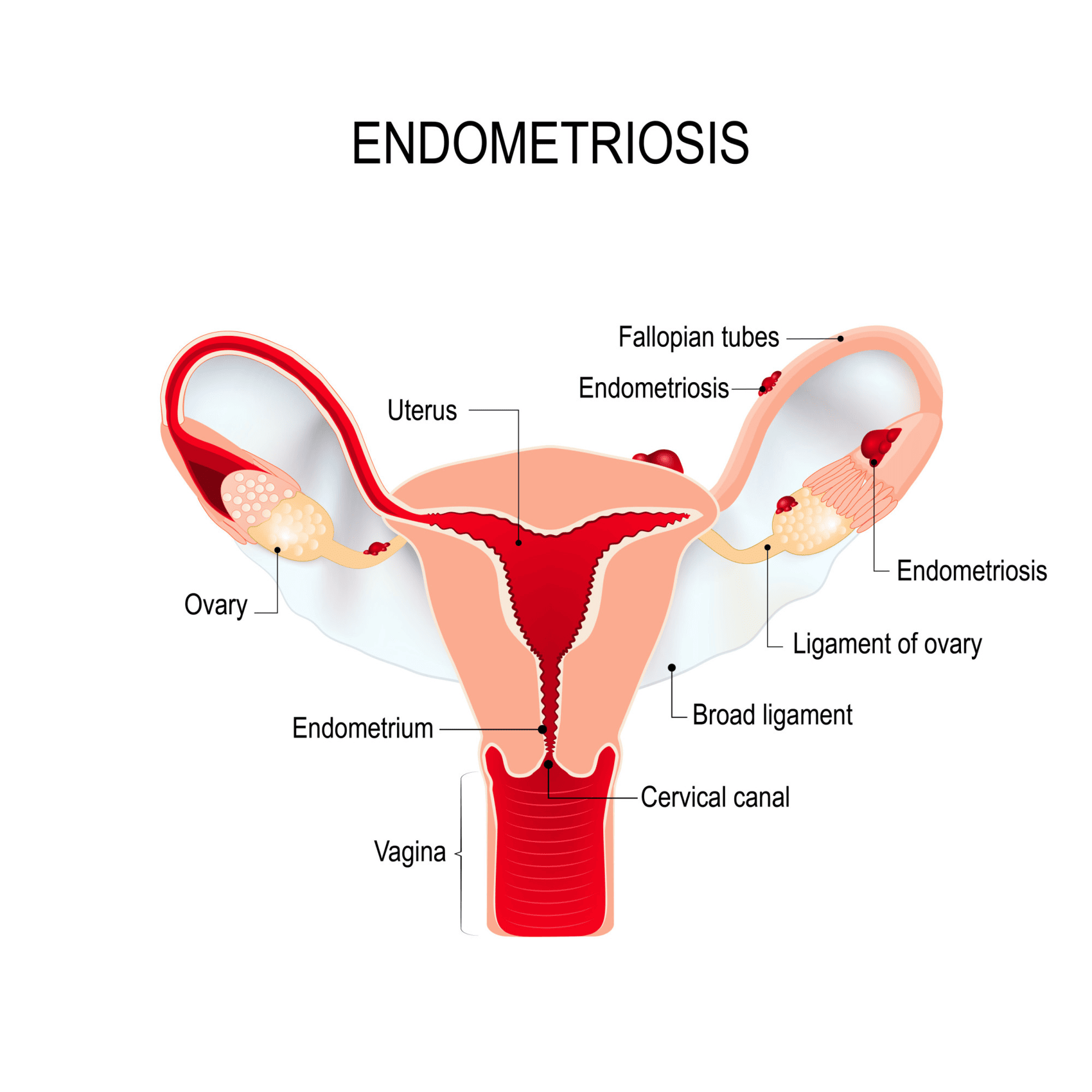 Image1_It’s Endometriosis Awareness Month: Facts & Infographic
