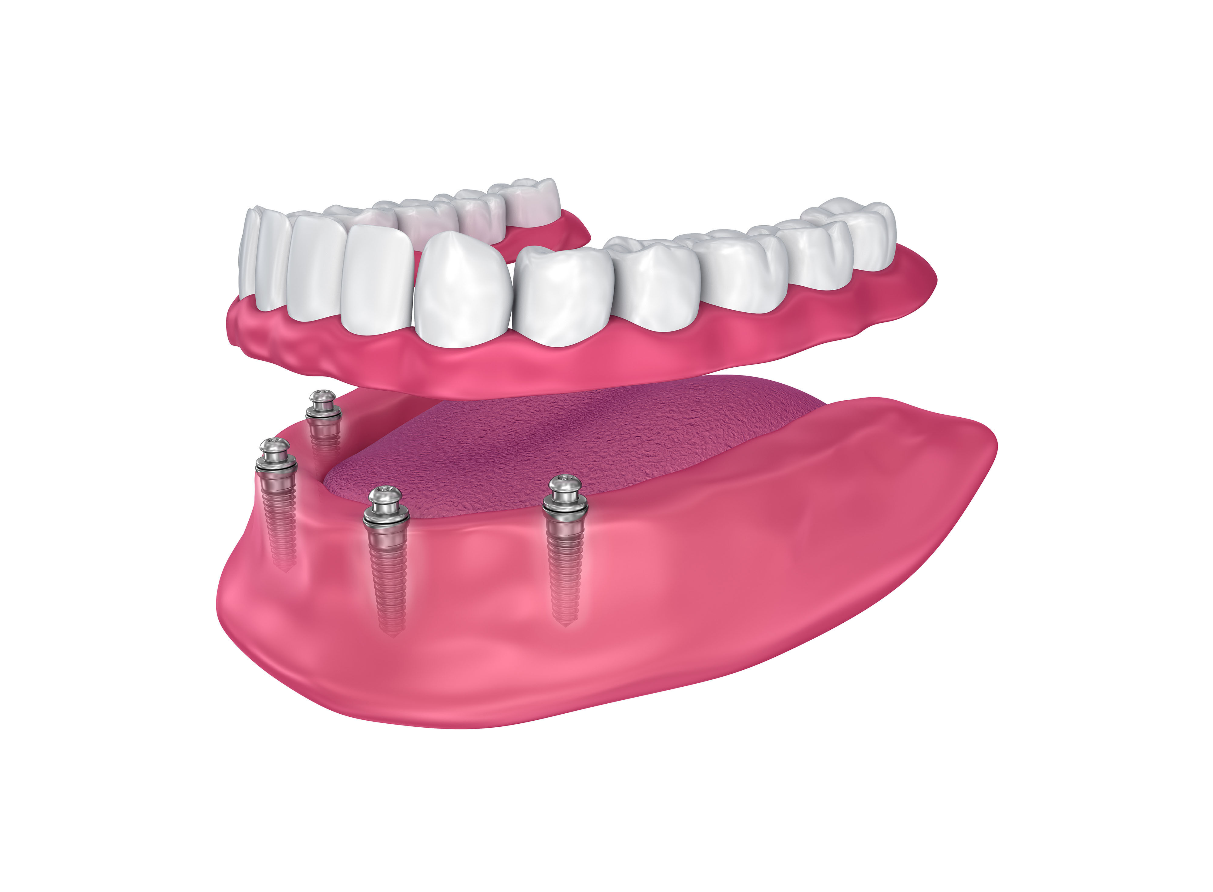 Image 3D d'implants dentaires all-on-4.