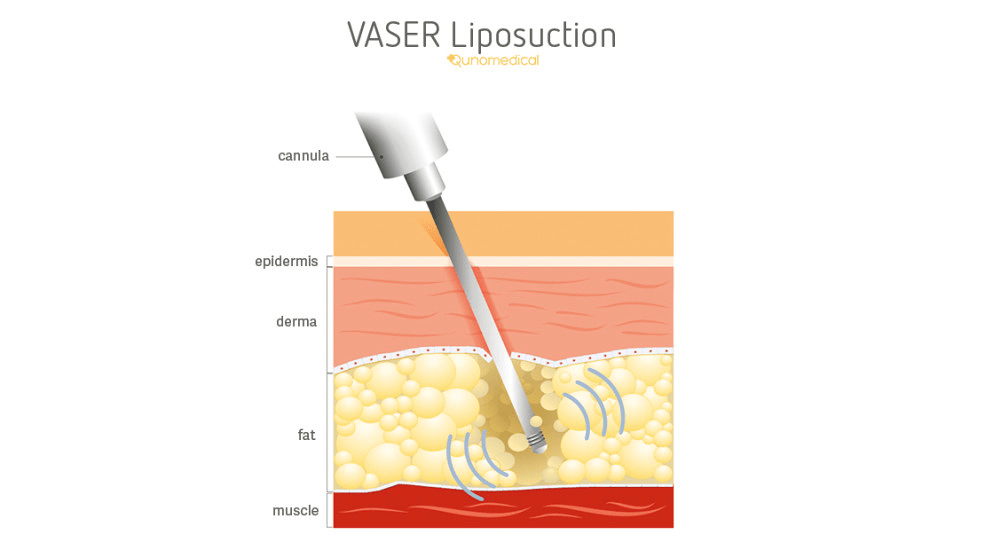 Illustration showing how a VASER liposuction procedure works.