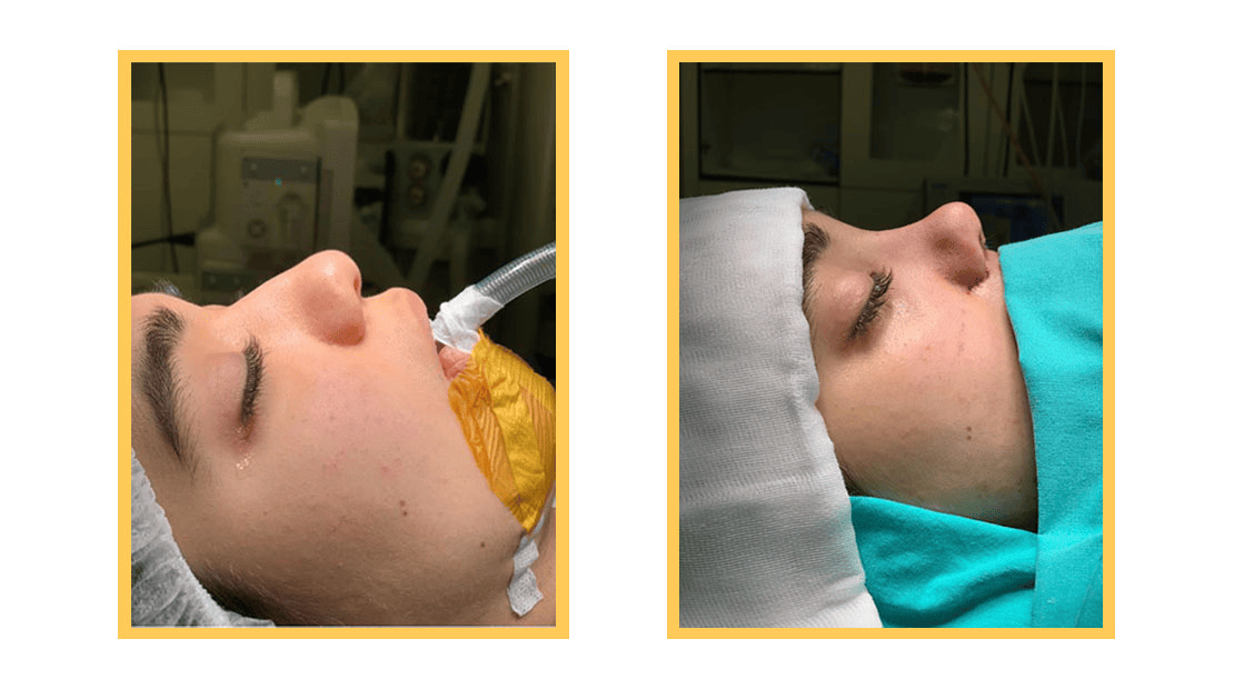 BlogPage_Image_Fereba rhinoplasty