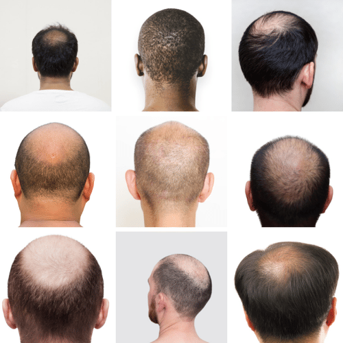 diferentes tipos de calvicie visto en la parte de atrás de la cabeza