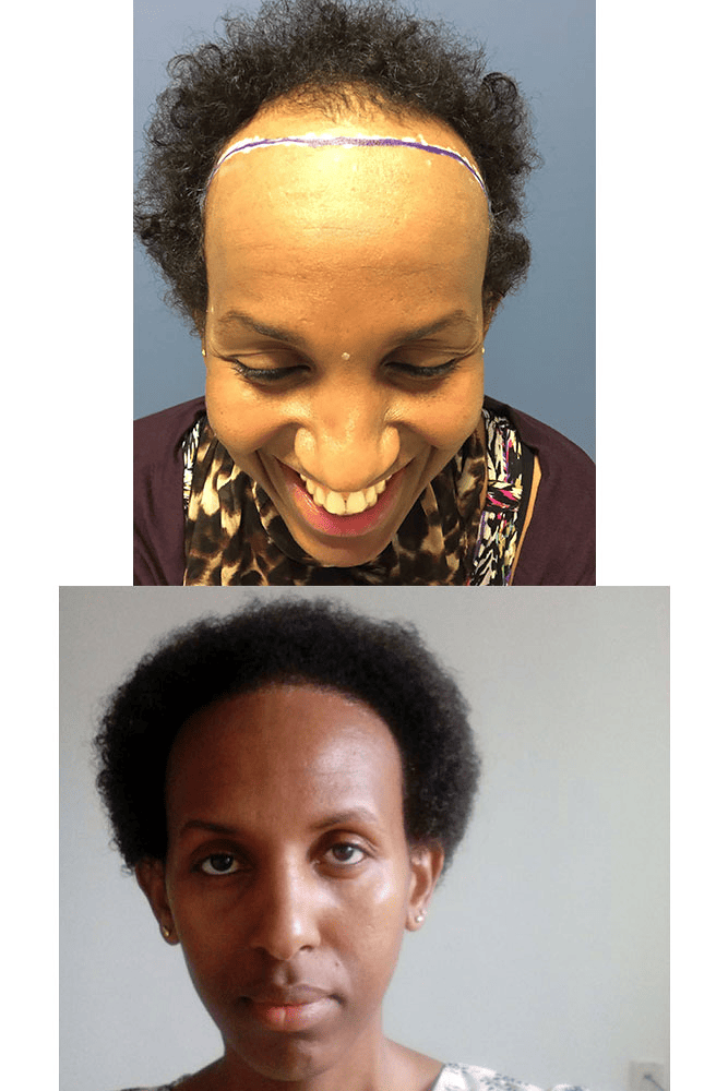 Trapianto di capelli afro presso Istanbul Aesthetic Center (IAC)