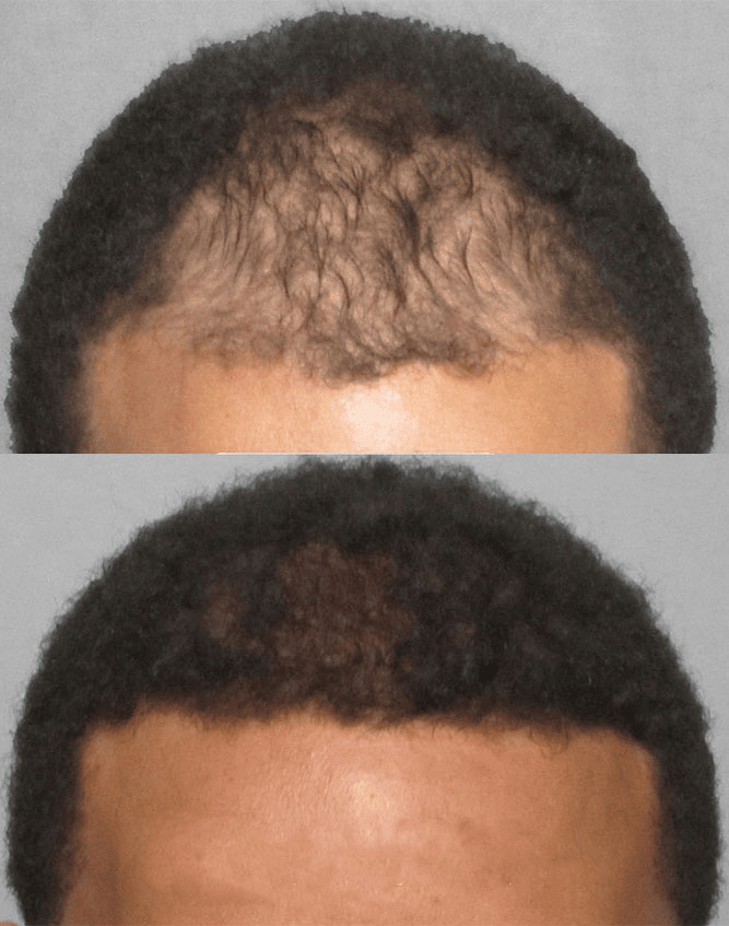 Trapianto di capelli afro al Dr. Cinik Hair Hospital