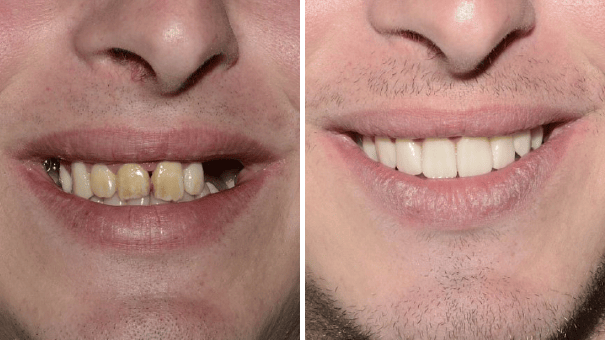 Man smiling and showing his teeth before and after undergoing dental implant surgery.