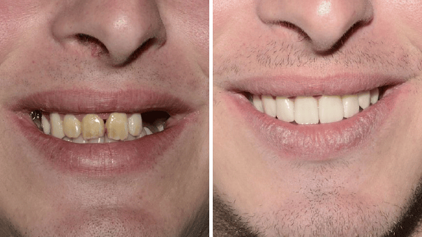 Man smiling and showing his teeth before and after undergoing dental implant surgery.