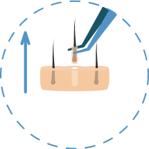Illustration of the second step in the DHI hair transplant procedure.
