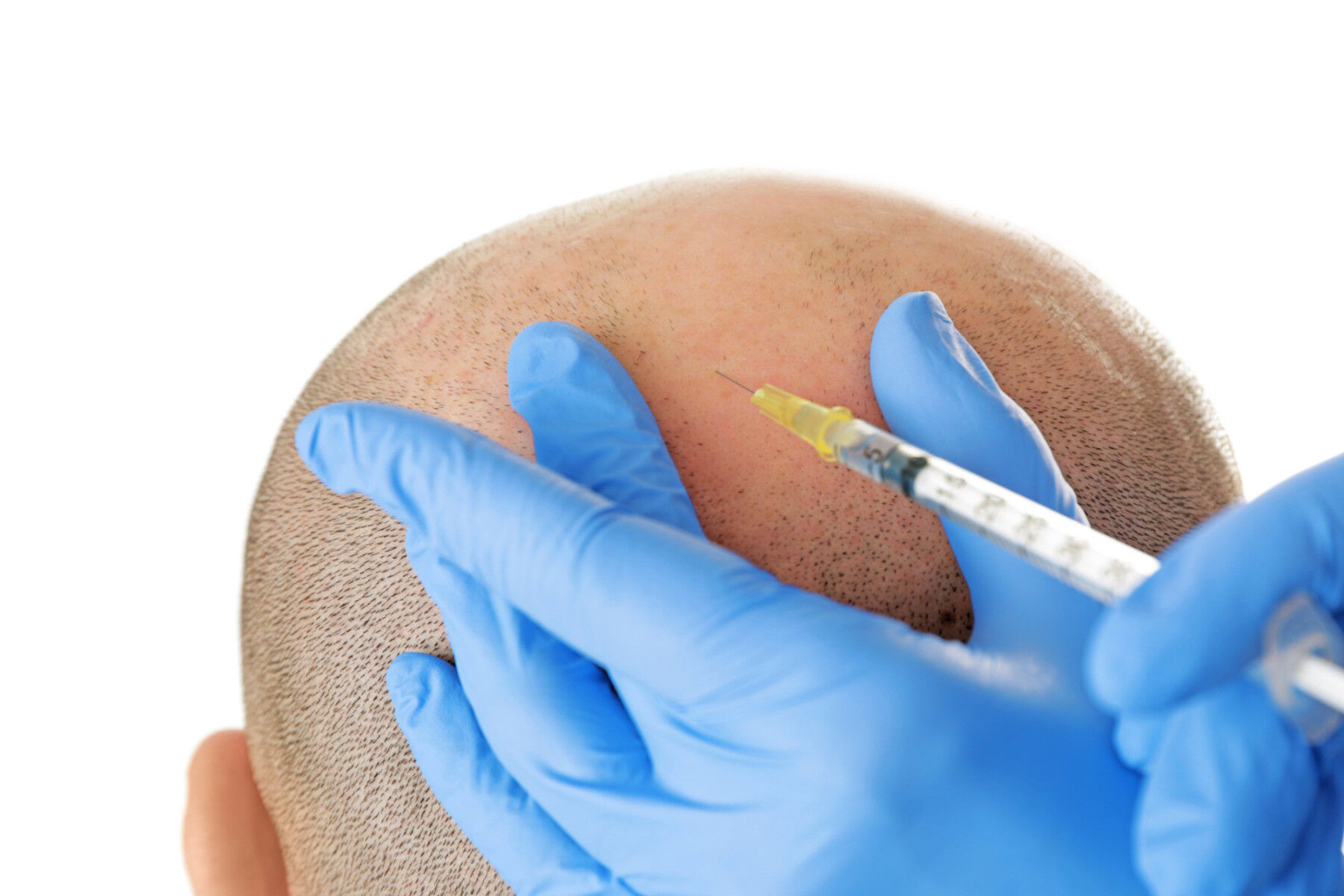 Preparazione e iniezione_cellule staminali prima di un trapianto di capelli