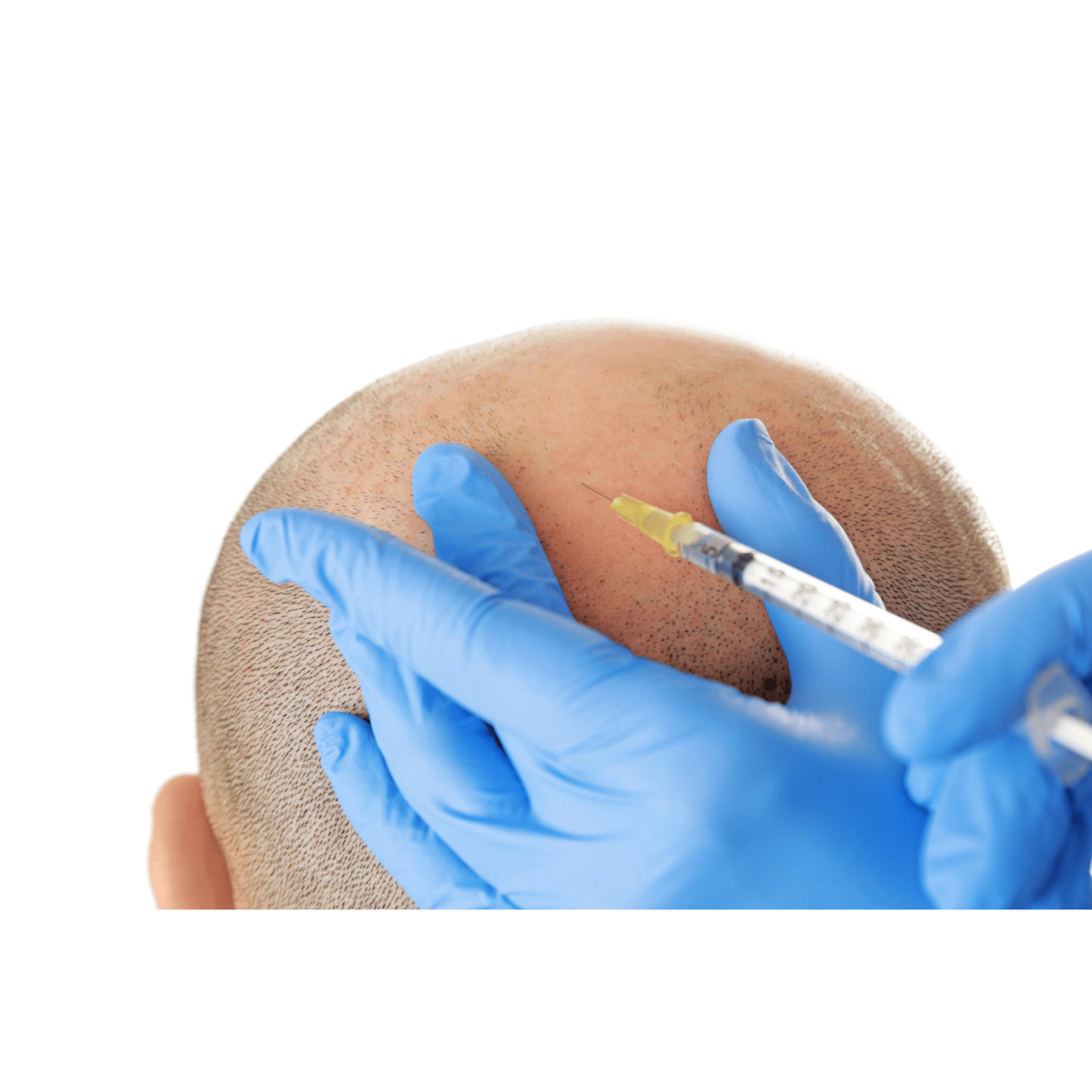 Preparazione e iniezione_cellule staminali prima di un trapianto di capelli