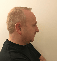 Image2_Eamon’s Hair Transplant Journey - Part I: Before Treatment