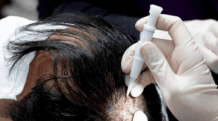 Hair graft harvesting and transplanting process