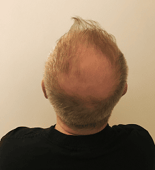 Image3_Eamon’s Hair Transplant Journey - Part I: Before Treatment