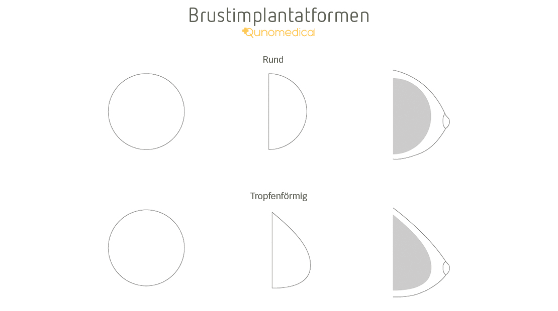 DE Gallery image 3 for brustvergrosserung-mit-implantaten