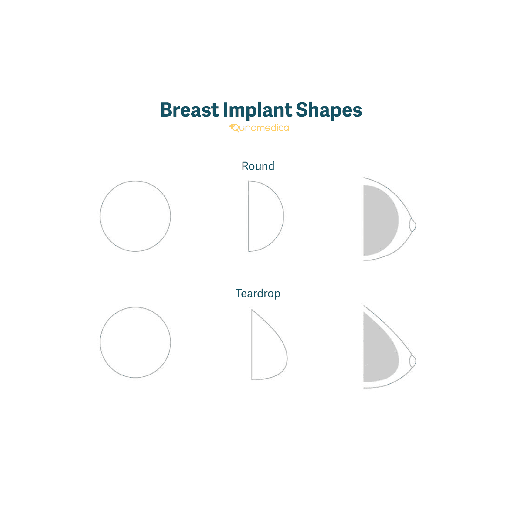 The different shapes of breast implants.