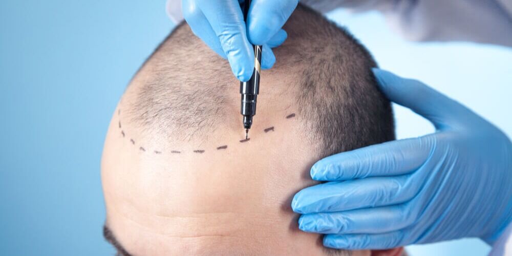 Bester Haartransplantationsspezialist arbeitet an einem Patienten