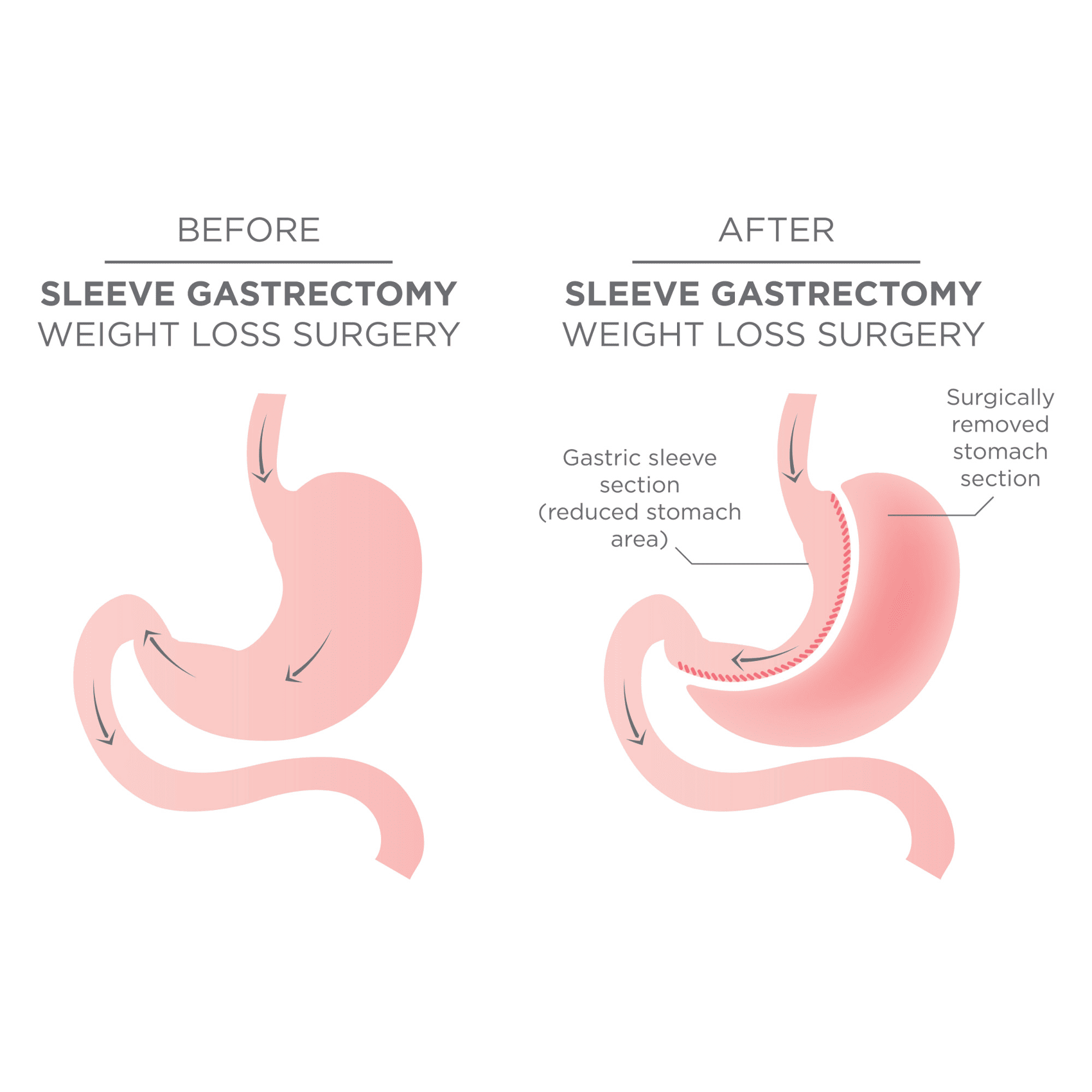 EN image 1 for Bariatric Surgery Cost Guide