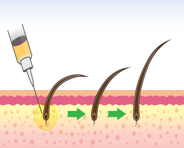 Image_Iniezione cellule staminali