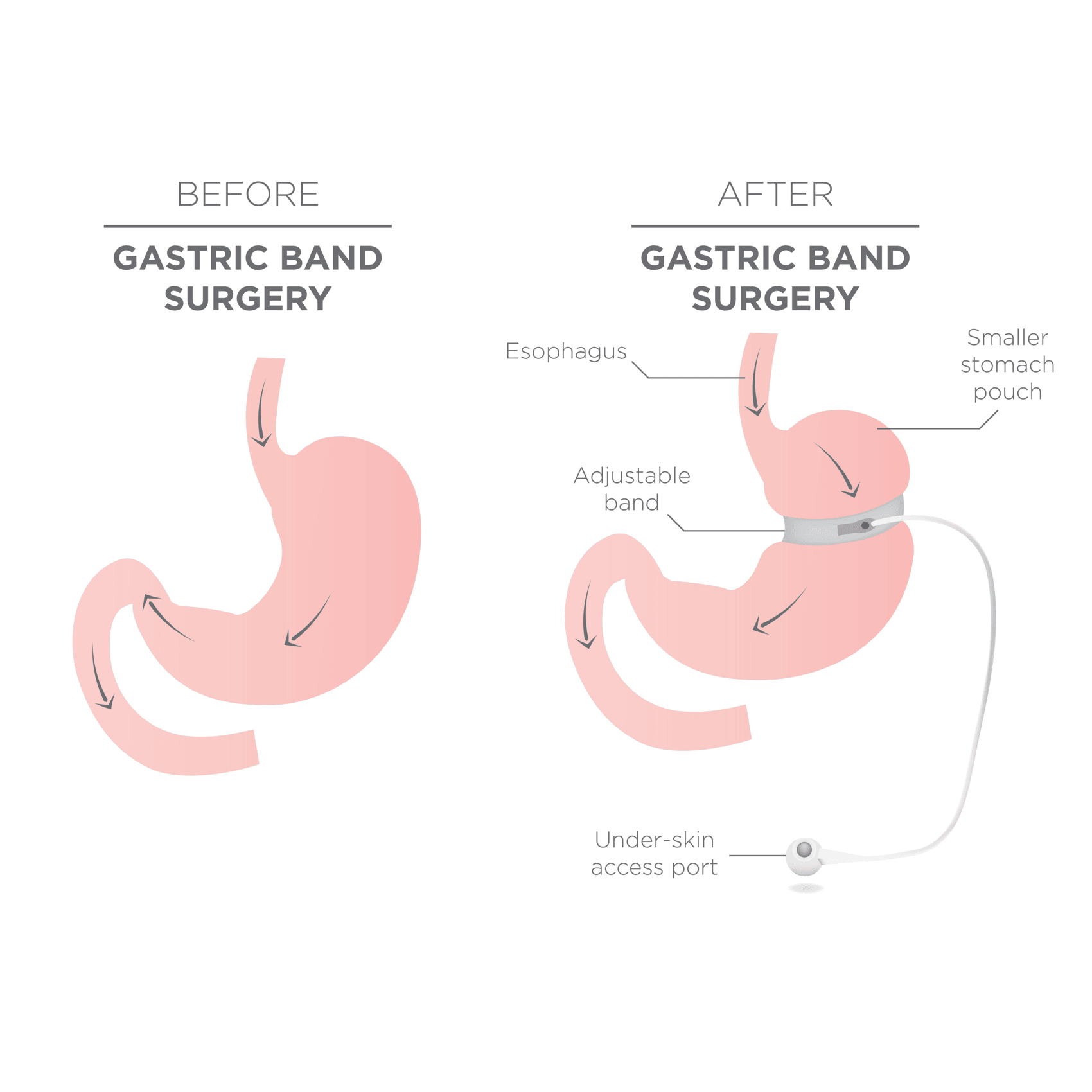 EN image 3 for Bariatric Surgery Cost Guide