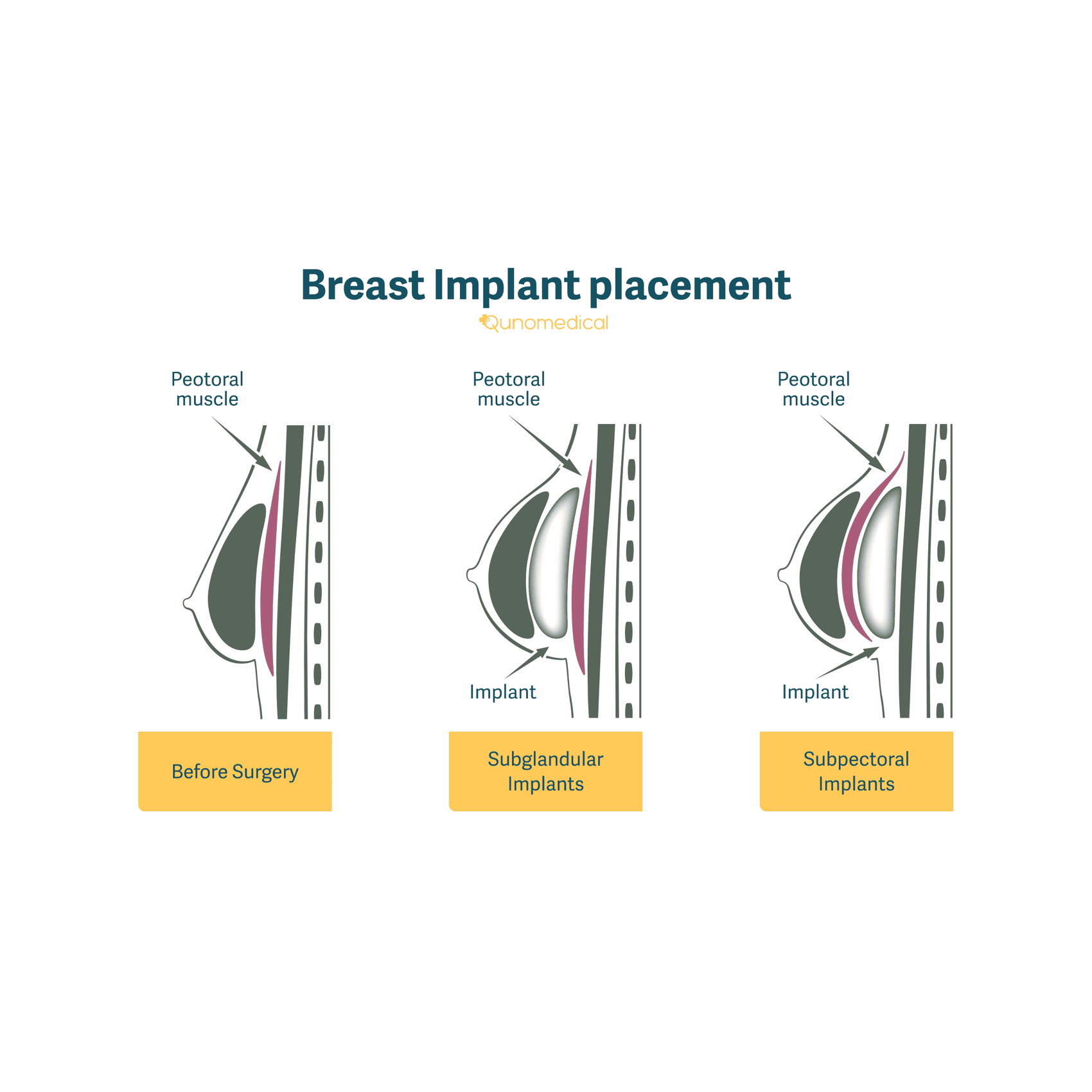 Illustration showing how breast implants are placed.