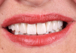 Best countries for dental implants female patient