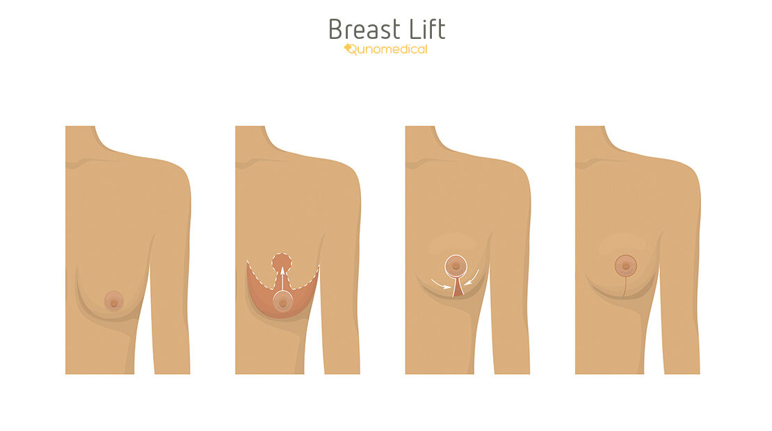 Diagram showing how breast lift surgery works.