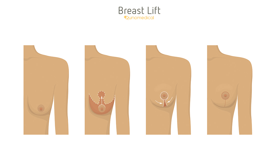 Diagram showing how breast lift surgery works.