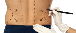 Patient planning a buttock and waist plastic surgery procedure.