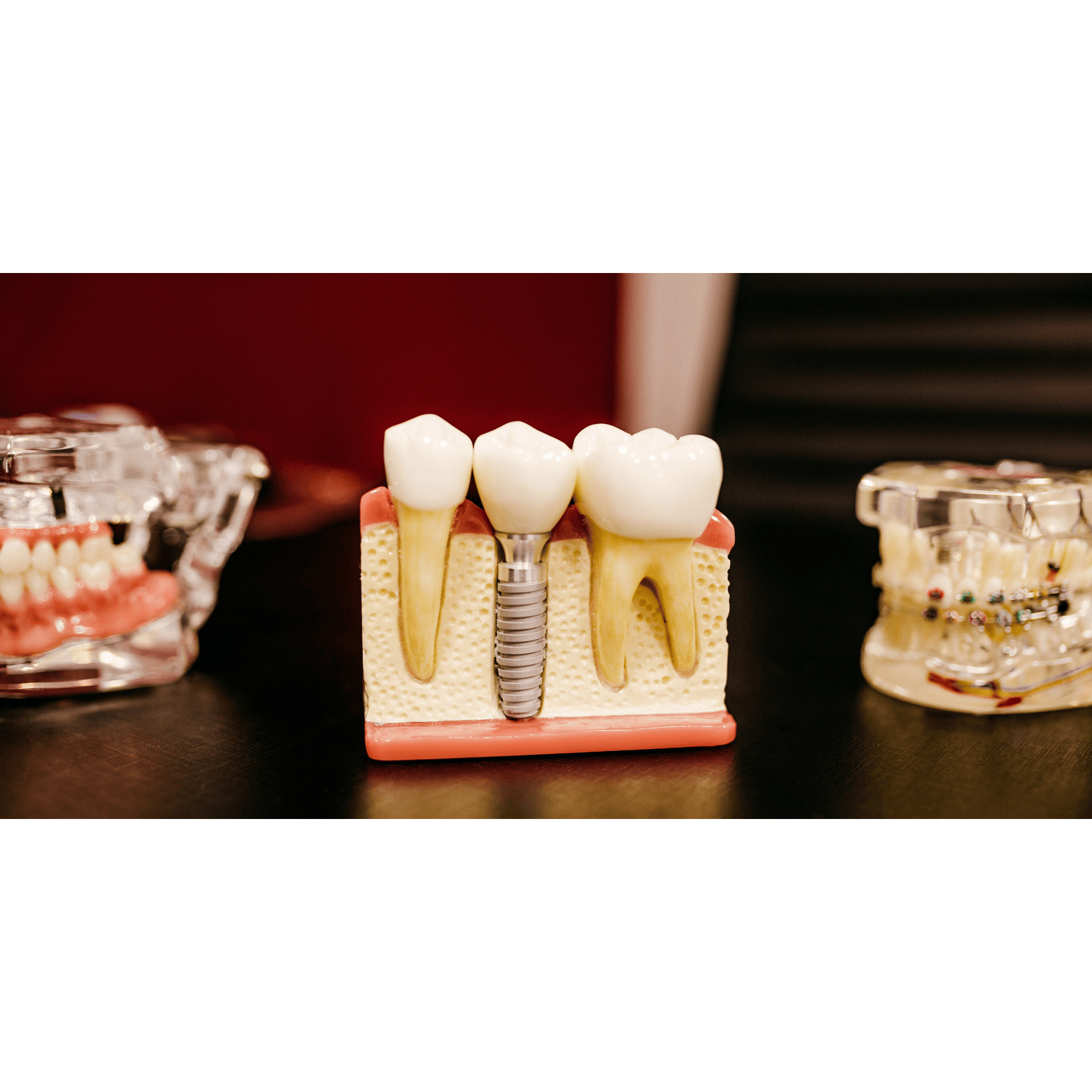 Blog_free-dental-implants-UK_image