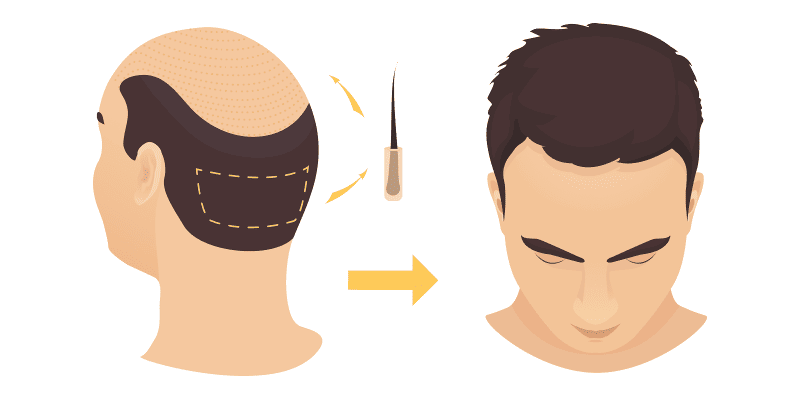 Illustration showing the end result following a hair transplant procedure.