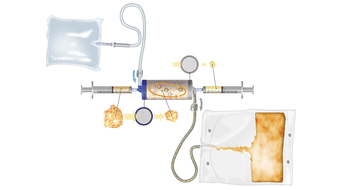 Image1_Ask The Expert: Lipogems As An Alternative To Orthopedic Surgery