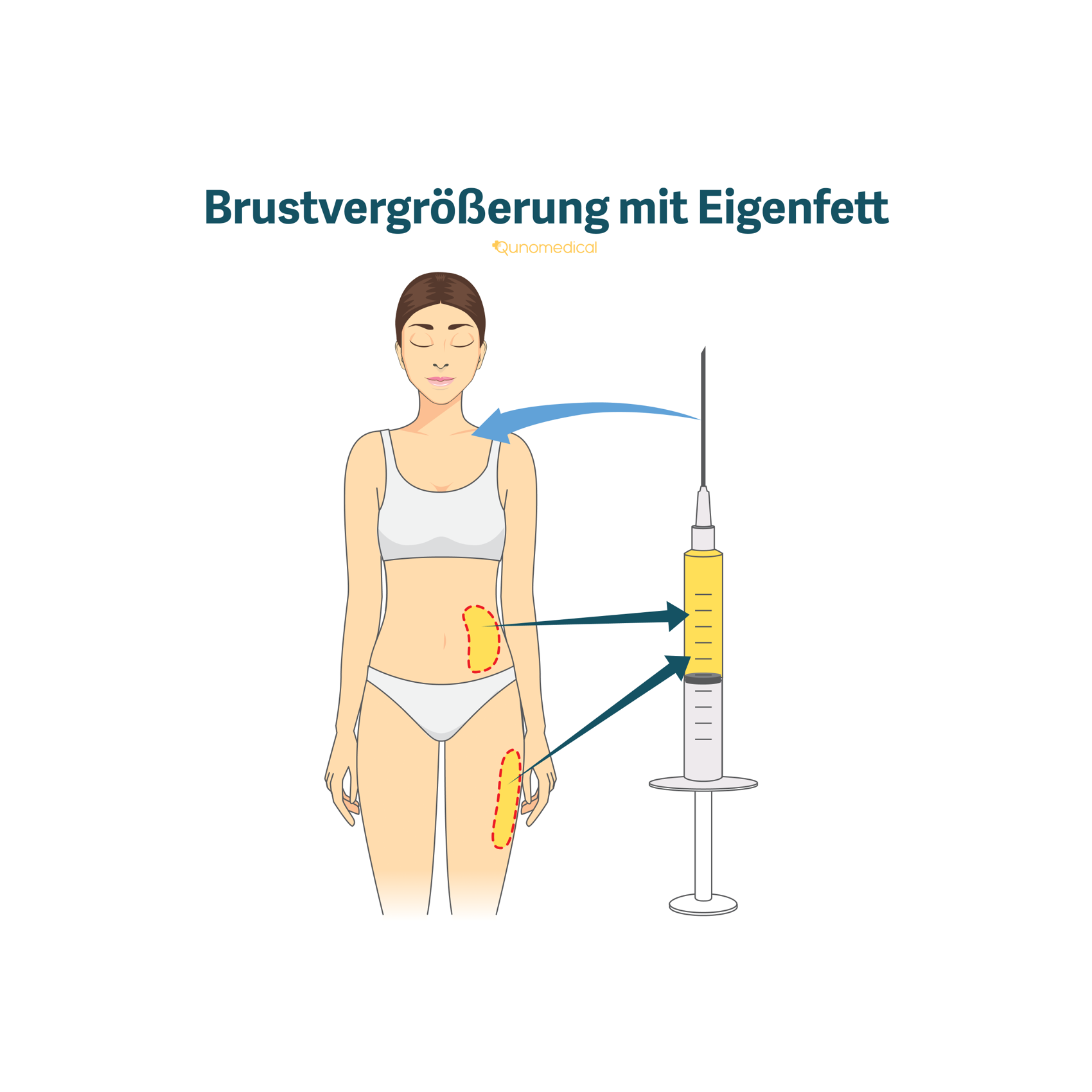 Brustvergrößerung mit Eigenfett
