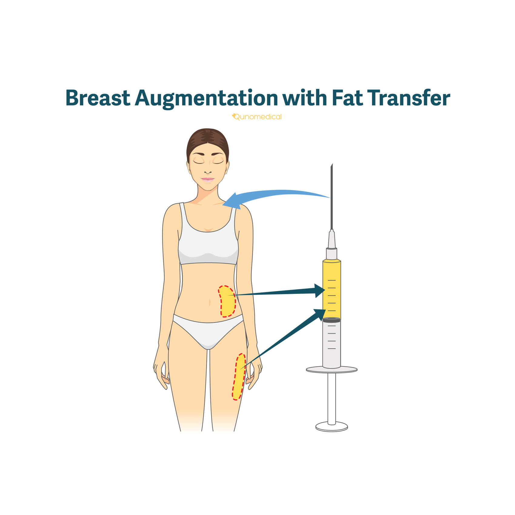 An illustration of how breast augmentation with fat transfer works.
