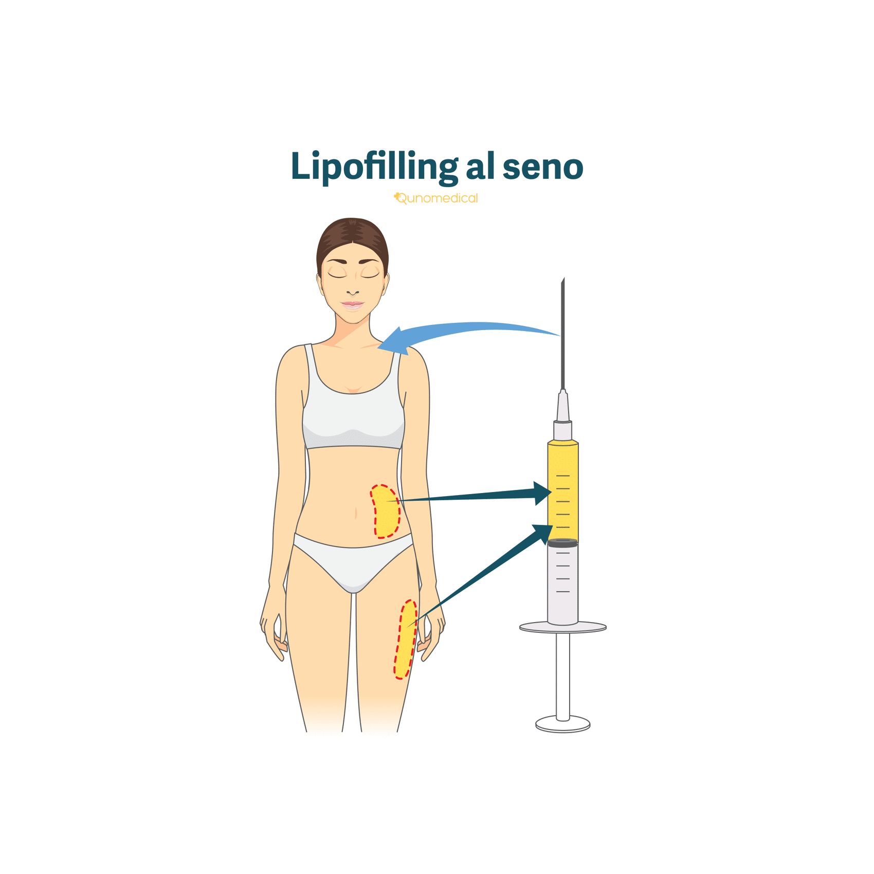 L'illustrazione mostra come funziona il lipofilling al seno.
