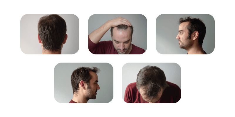 Example showing the pictures needed for an initial FUE hair transplant assessment.