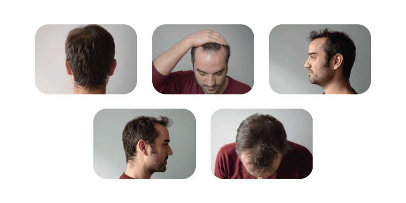 Voorbeeld van de foto's die nodig zijn voor een eerste beoordeling van een FUE haartransplantatie.