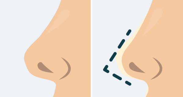 Before and after illustration of an augmentation rhinoplasty.