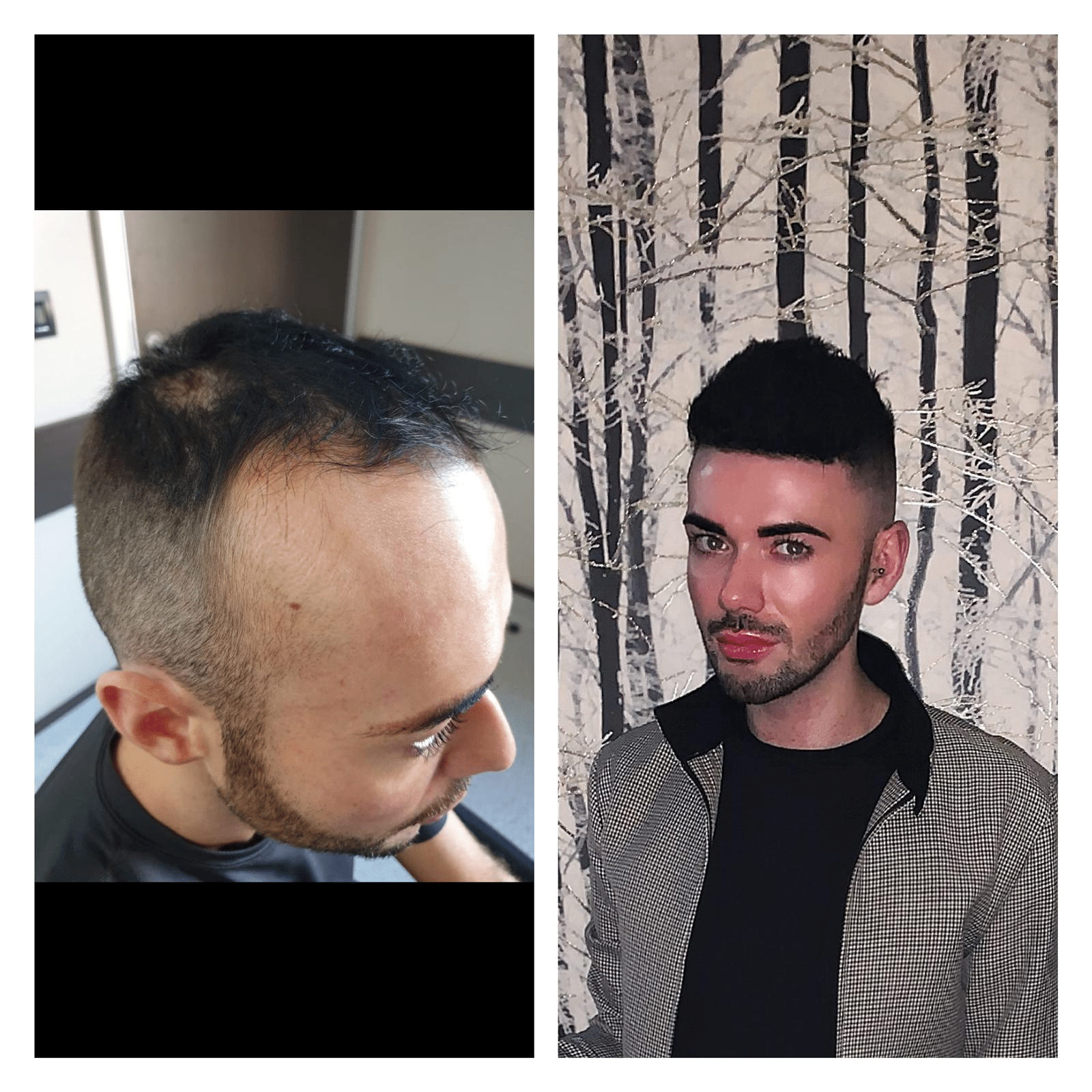 Qunomedical Interviews: Iwan's Hair Transplant in Turkey_Image4